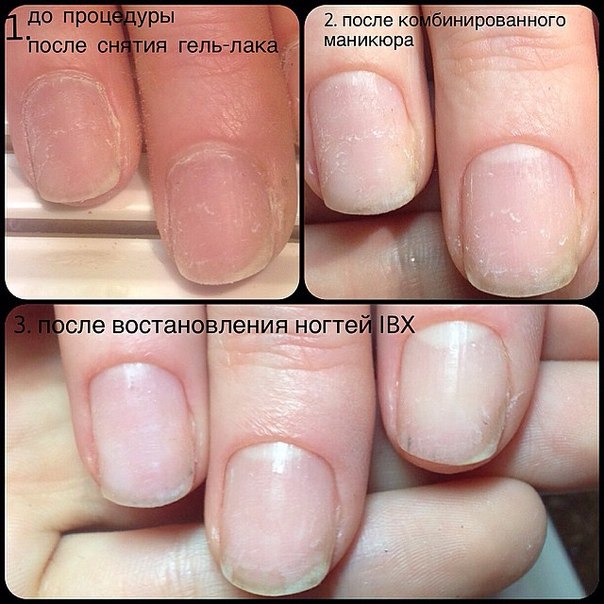 Последствия после гель-лака. Как восстановить ногти и как правильно делать покрытие.